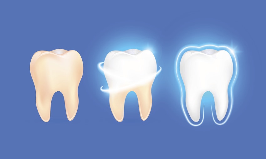Illustration of teeth with various degrees of whitening