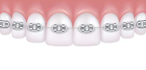 Illustration of a top row of teeth with traditional metal dental braces attached