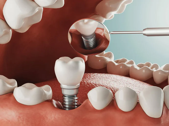 Dental implants in Cincinnati, OH at Moorehead Dentistry.