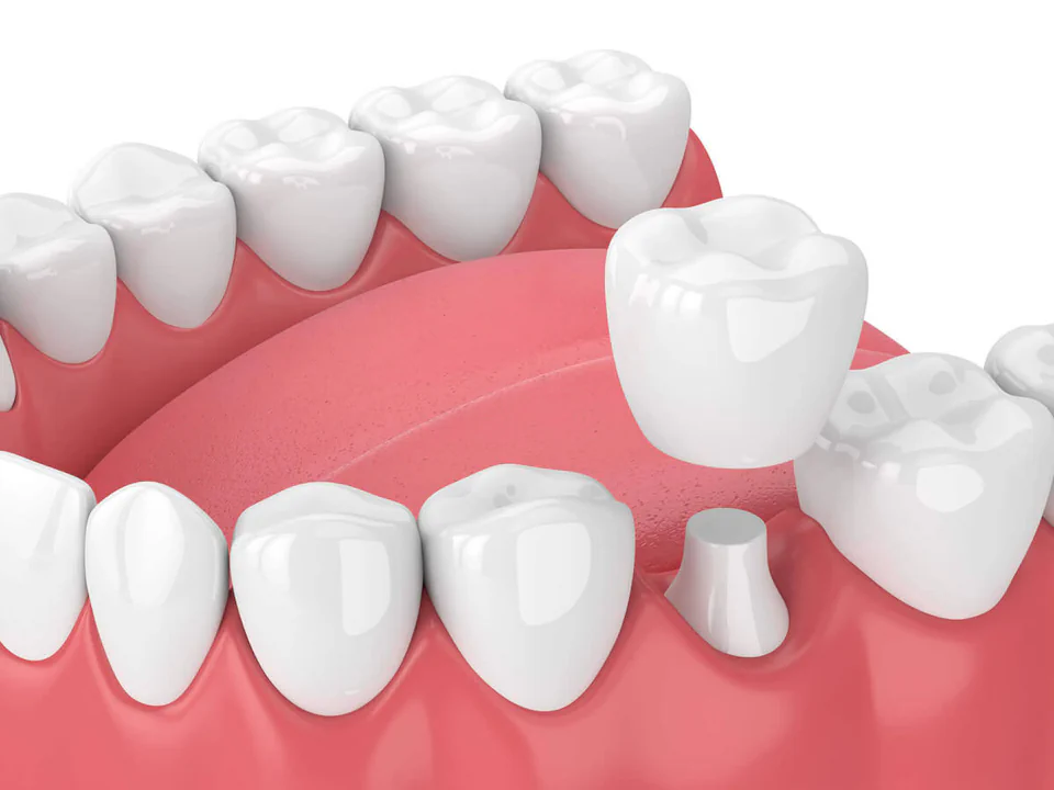 Dental crowns and dental bridges in Cincinnati, OH at Moorehead Dentistry.