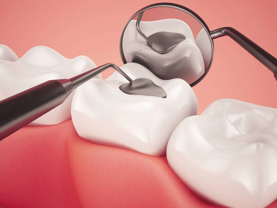 Dental fillings and dental sealants in Cincinnati, OH at Moorehead Dentistry.
