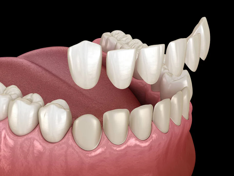 Dental veneers in Cincinnati, OH at Moorehead Dentistry.
