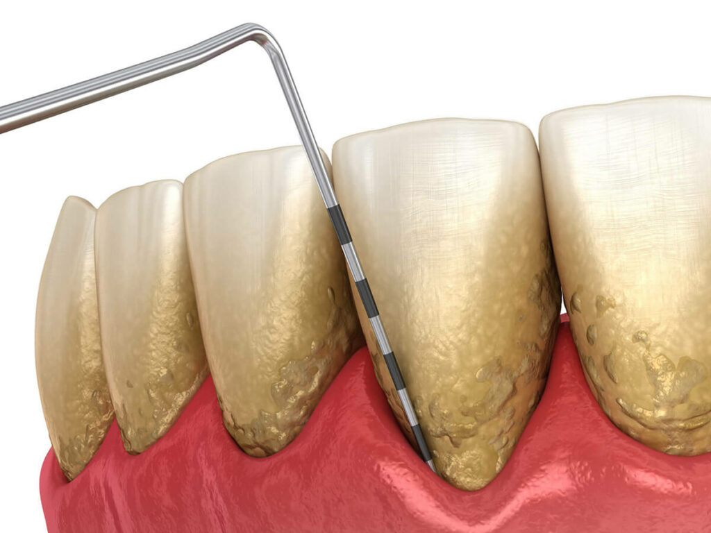 gum disease measuring