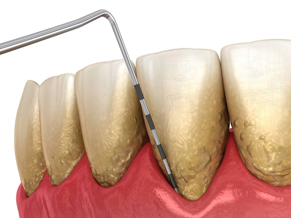 Gum disease treatment in Cincinnati, OH at Moorehead Dentistry.