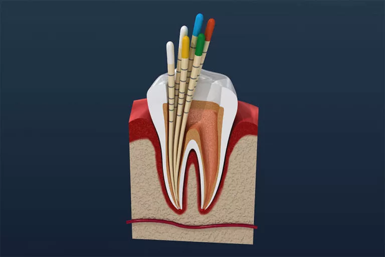 illustration of a tooth with roots obstructed, indicating that a root canal is needed