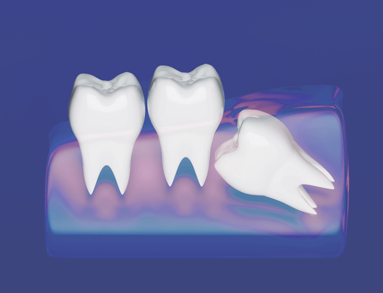 impacted wisdom teeth
