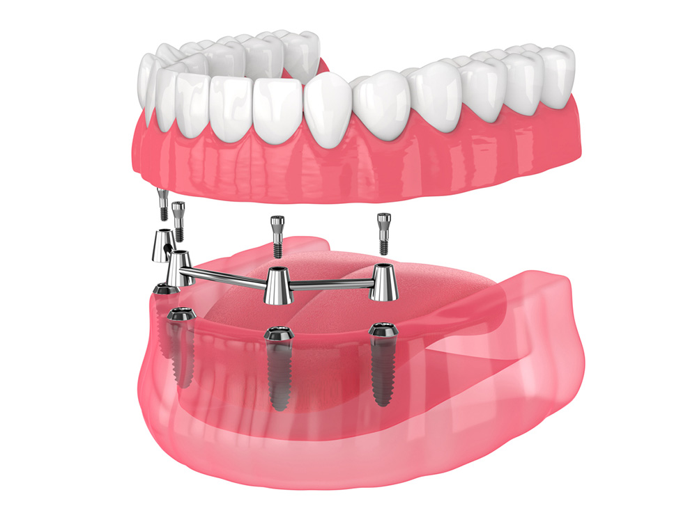 3D illustration of all-on-4 implants fitting onto lower arch