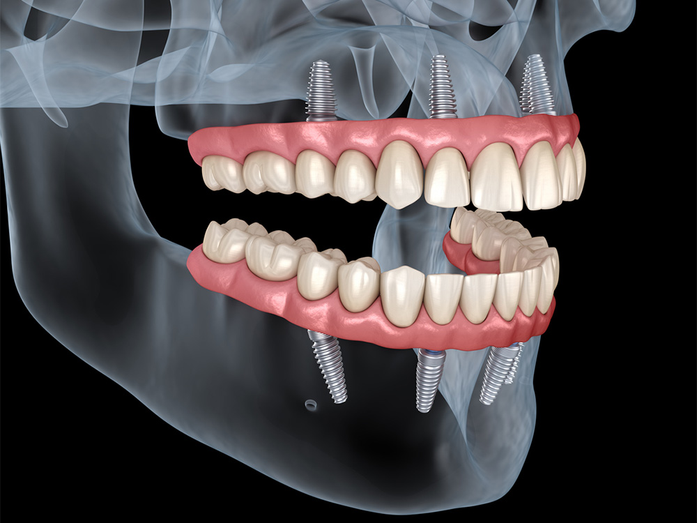 Illustration showing all-on-4 dental implants on top and bottom arches