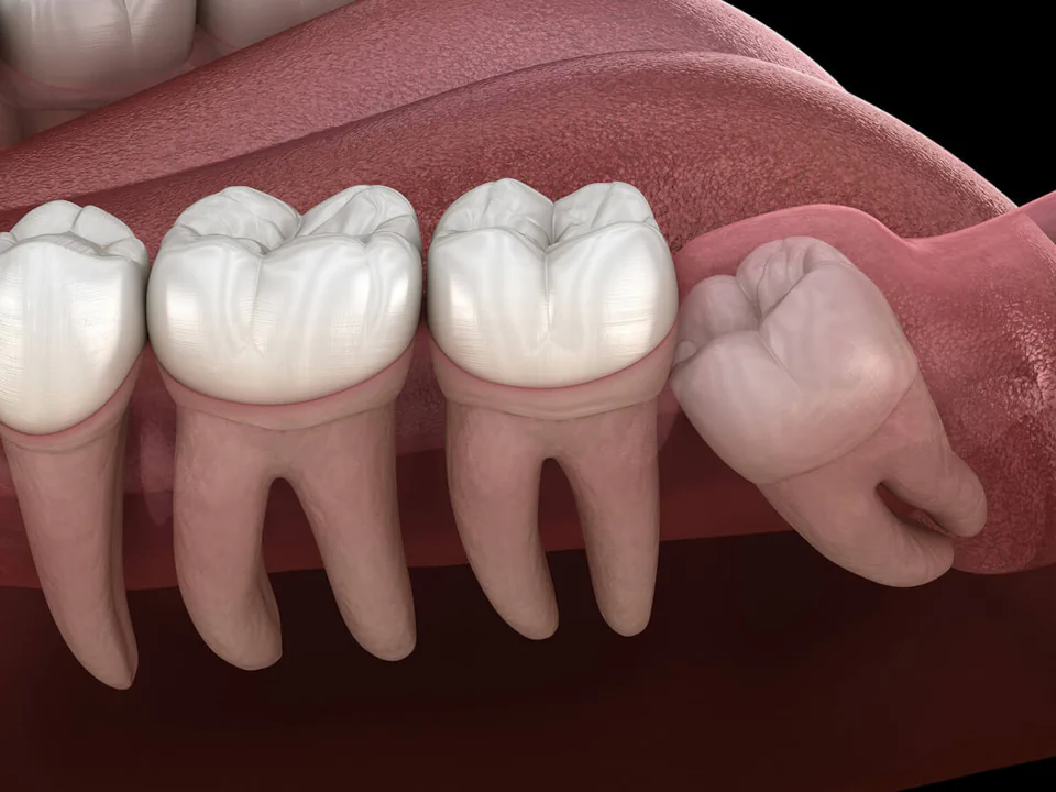 Wisdom teeth removal in Cincinnati, OH at Moorehead Dentistry.