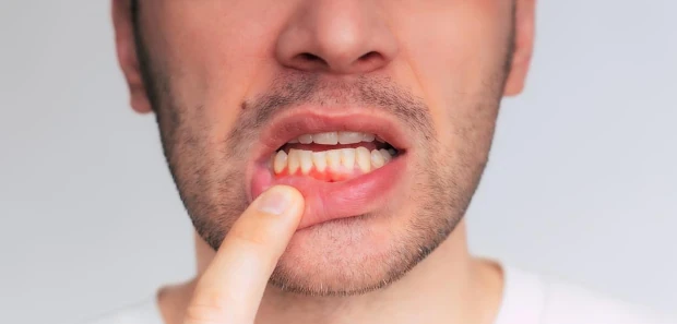 The Larger Effects of Gum Disease on Your Health.